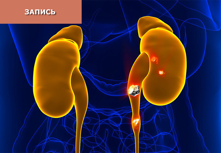 Лечение мочекаменной болезни методами китайской медицины